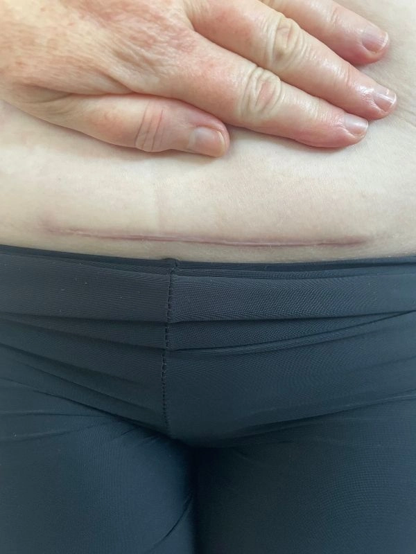 Mairi Taylor shows the results of performing a therapeutic massage on a C Section Scar on a torso.